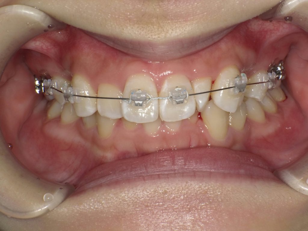 スタッフの矯正治療記録〜装置装着〜