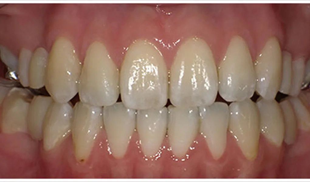 4か月後（挙式直前 抜歯部位にダミーの仮歯を装着）