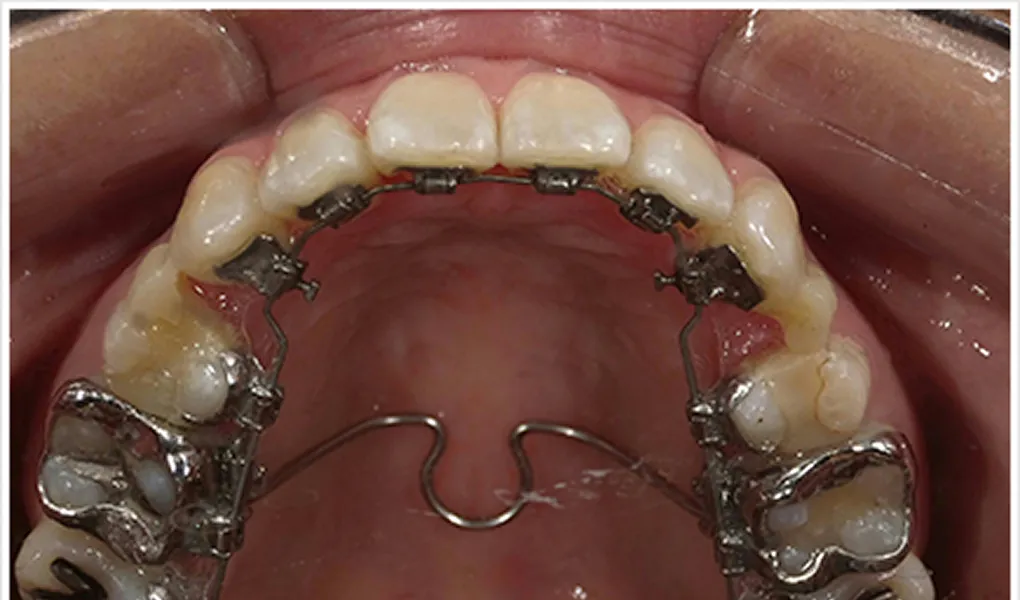  4か月後（挙式直前 抜歯部位にダミーの仮歯を装着）