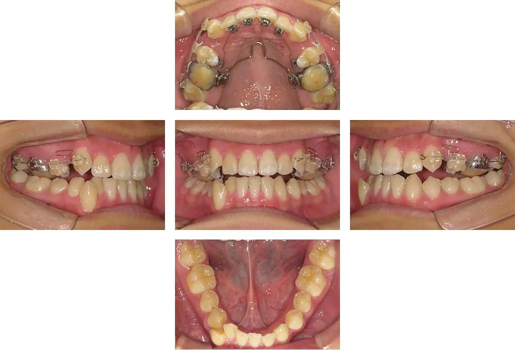 治療経過（動的治療開始時）