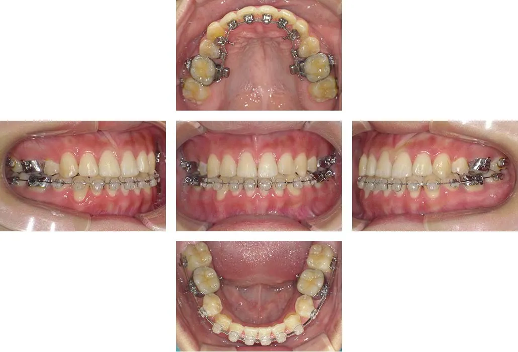 治療経過（動的治療終了時）