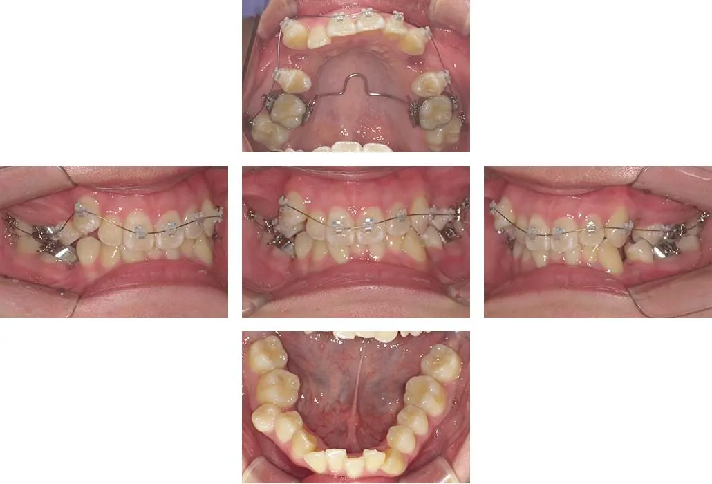 治療経過（動的治療開始時）