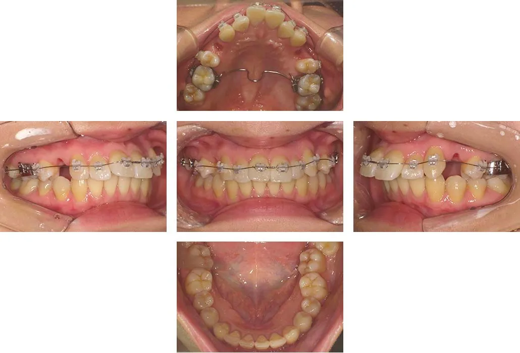 治療経過（動的治療開始時）
