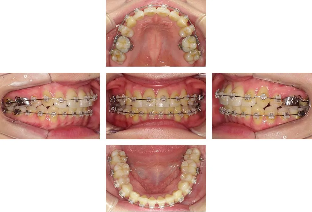 治療経過（動的治療終了時）
