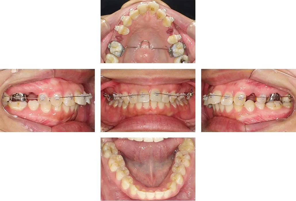 治療経過（動的治療開始時）