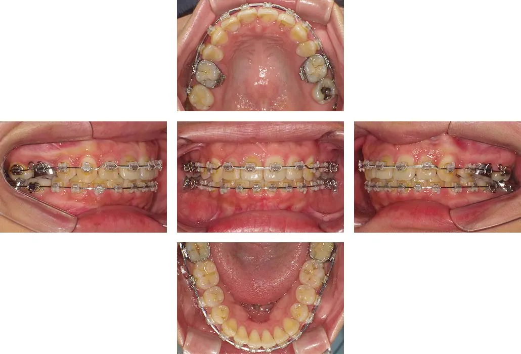 治療経過（動的治療終了時）