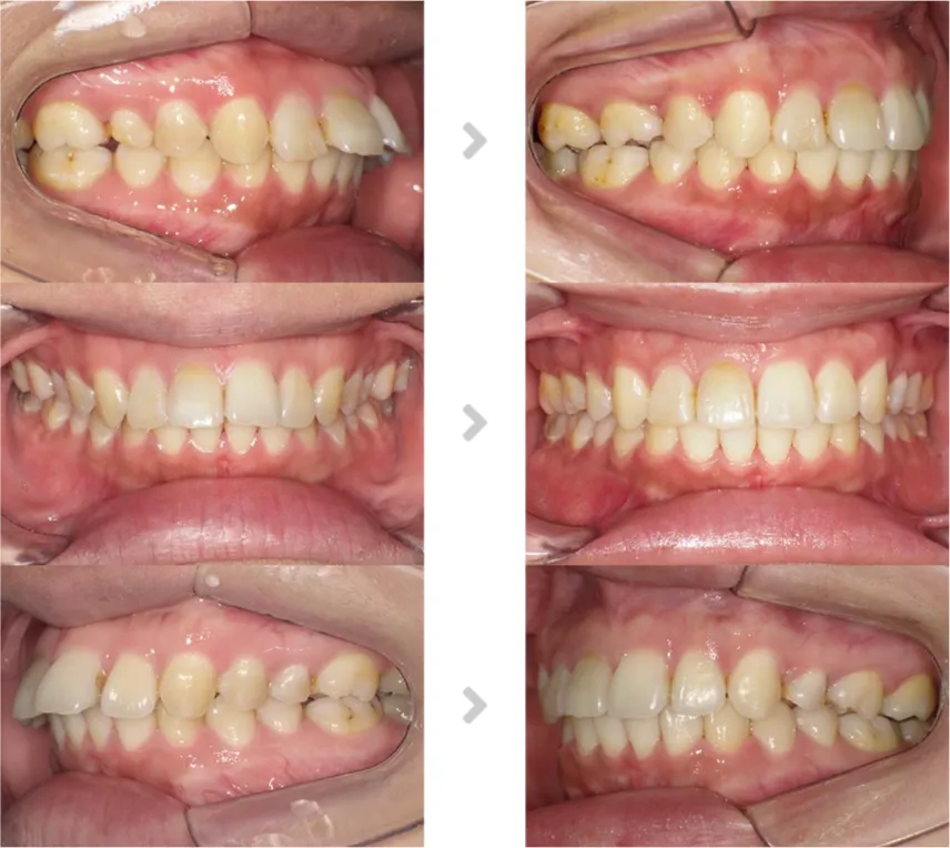 術前術後の比較