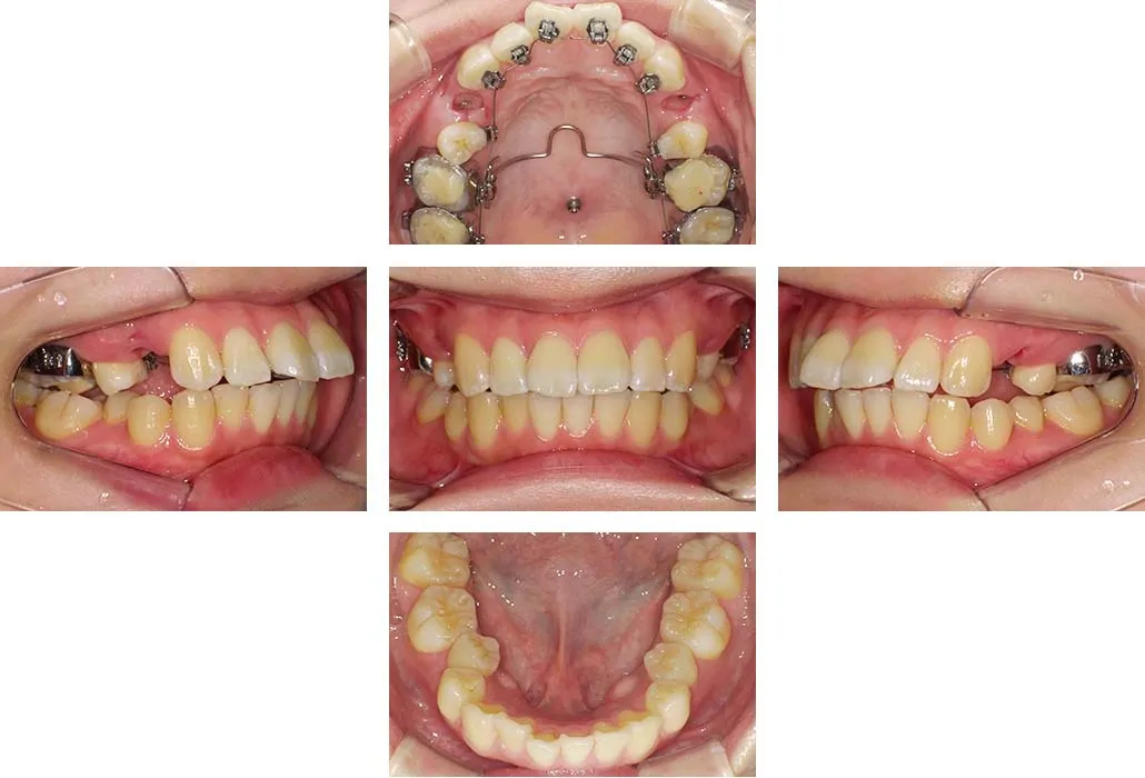 治療経過（動的治療開始時）