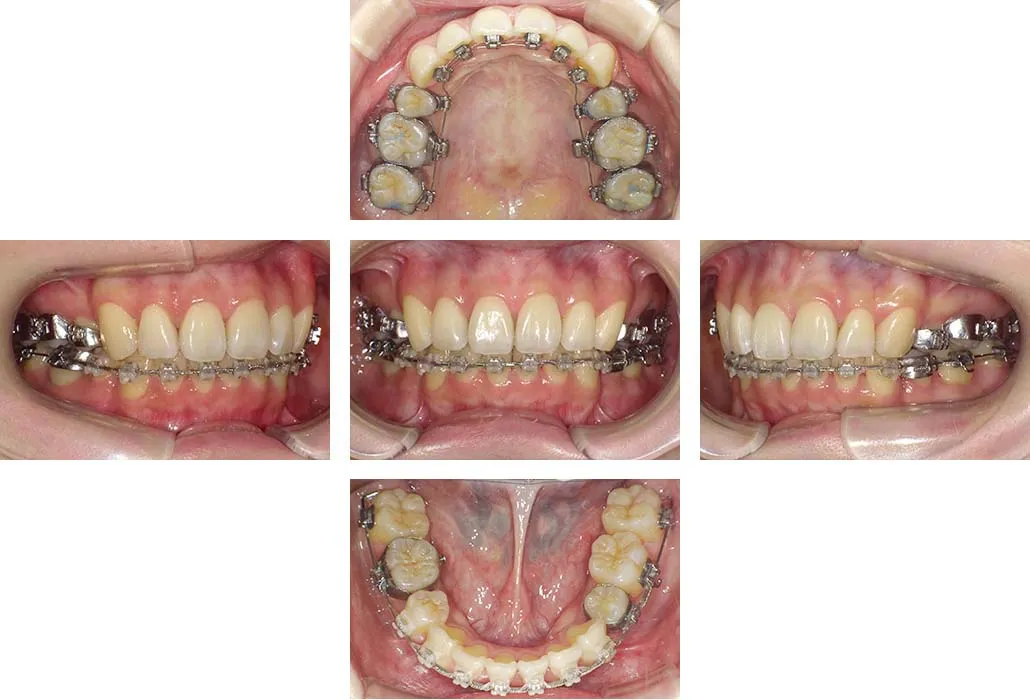 治療経過（動的治療終了時）