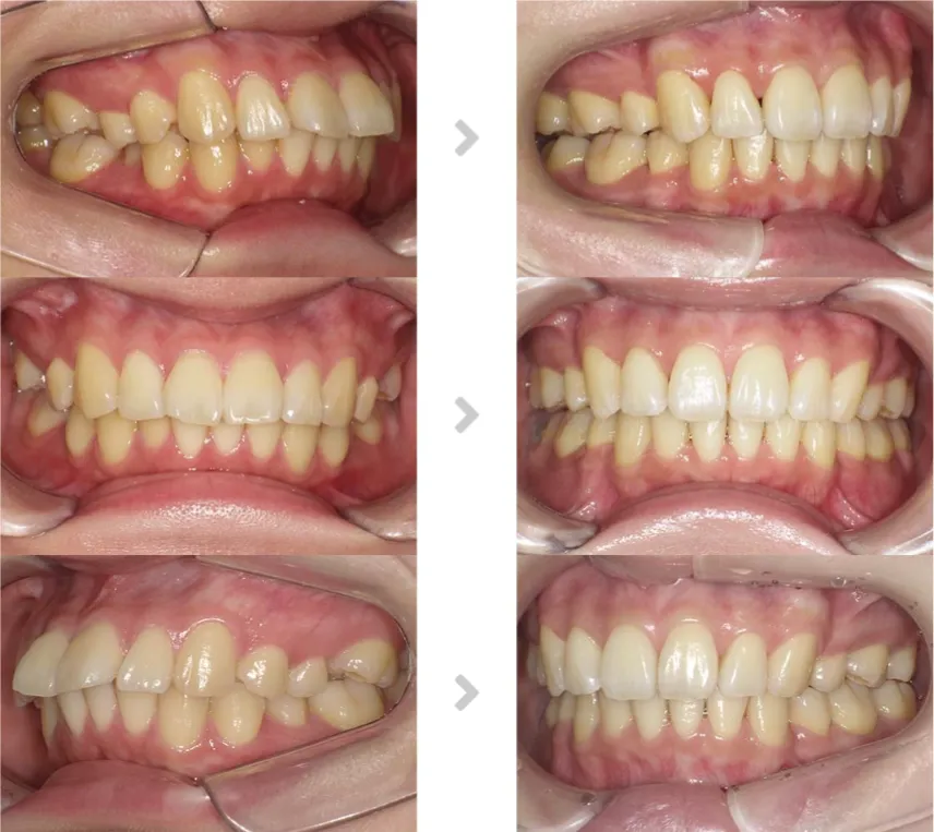 術前術後の比較