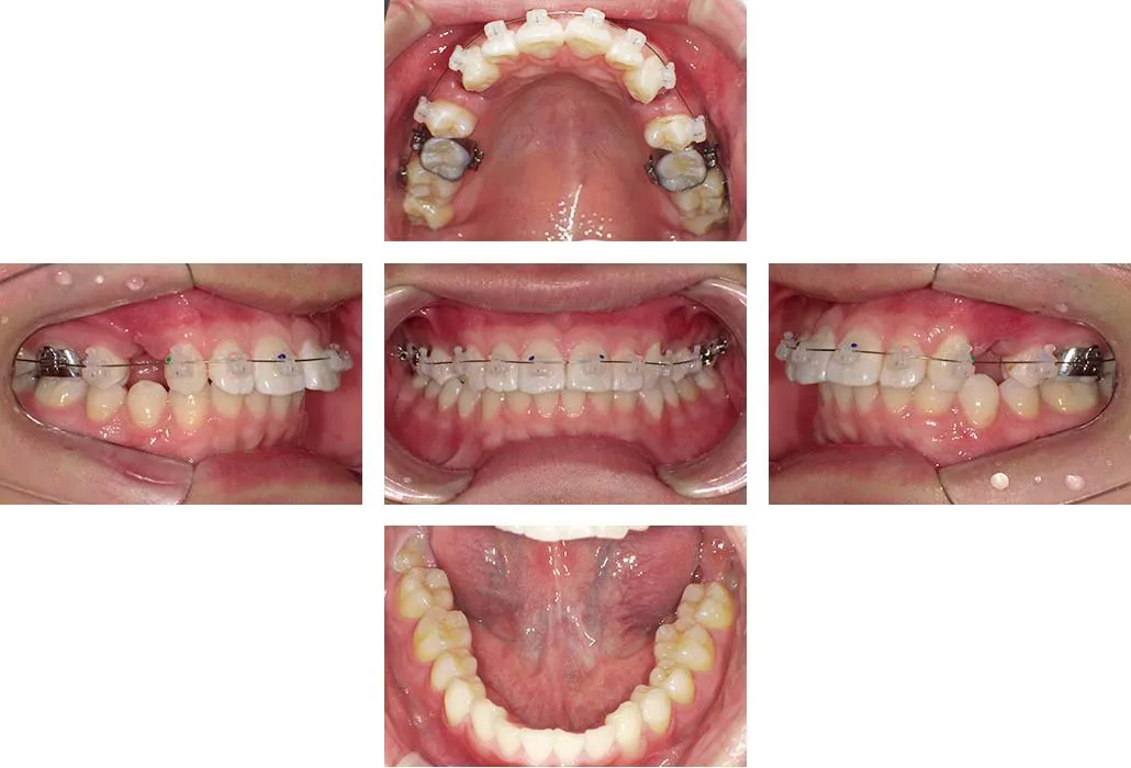 治療経過（動的治療開始時）