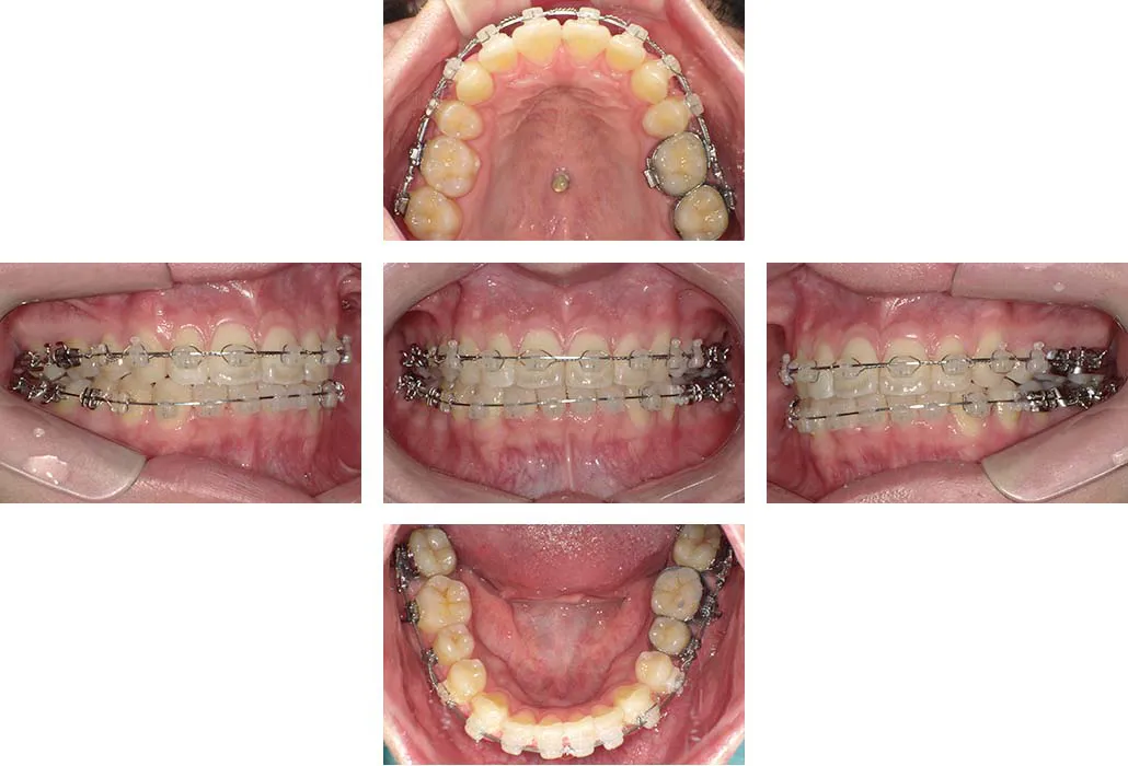 治療経過（動的治療終了時）
