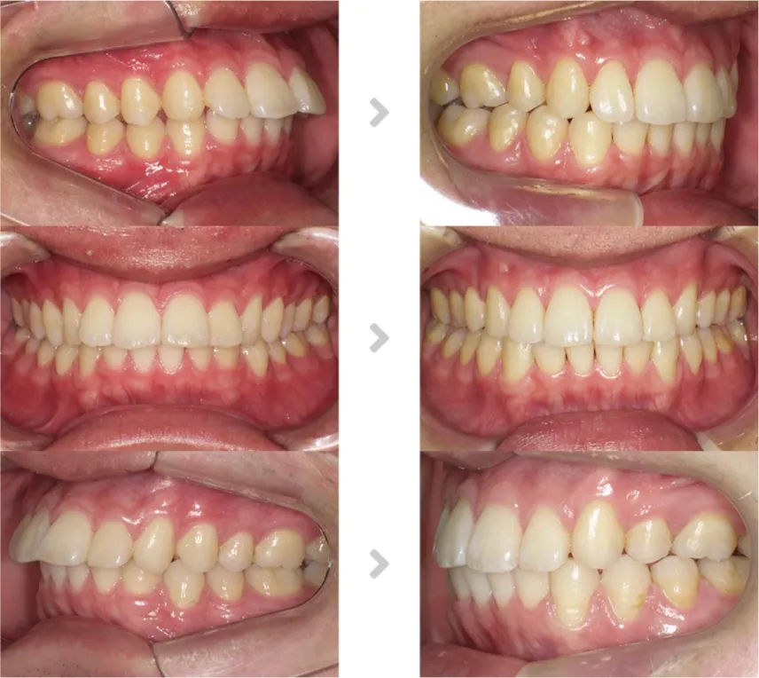 術前術後の比較