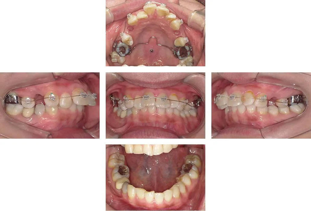 治療経過（動的治療開始時）