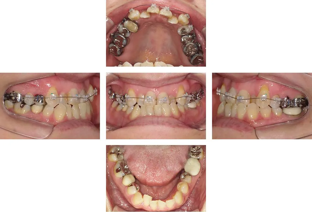 治療経過（動的治療開始時）