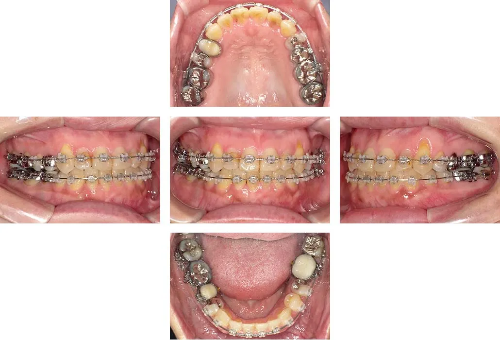 治療経過（動的治療終了時）