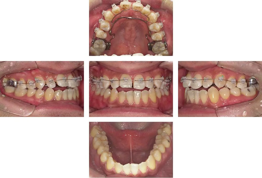 治療経過（動的治療開始時）