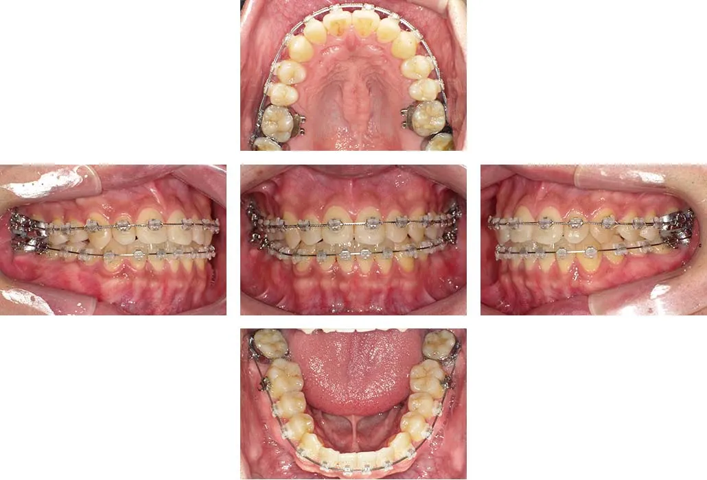 治療経過（動的治療終了時）