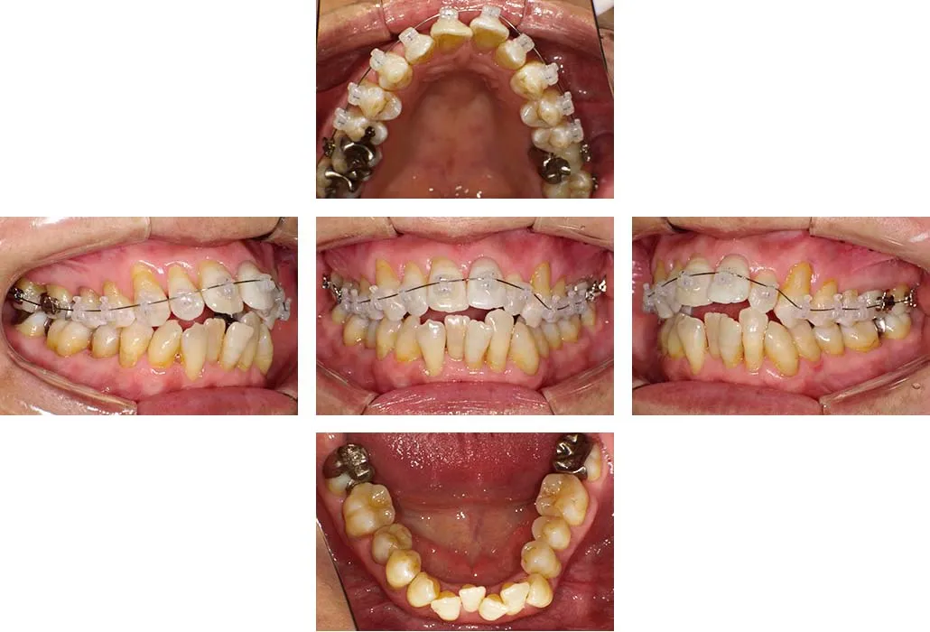 治療経過（動的治療開始時）