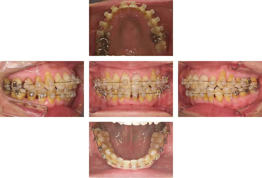 治療経過（動的治療終了時）