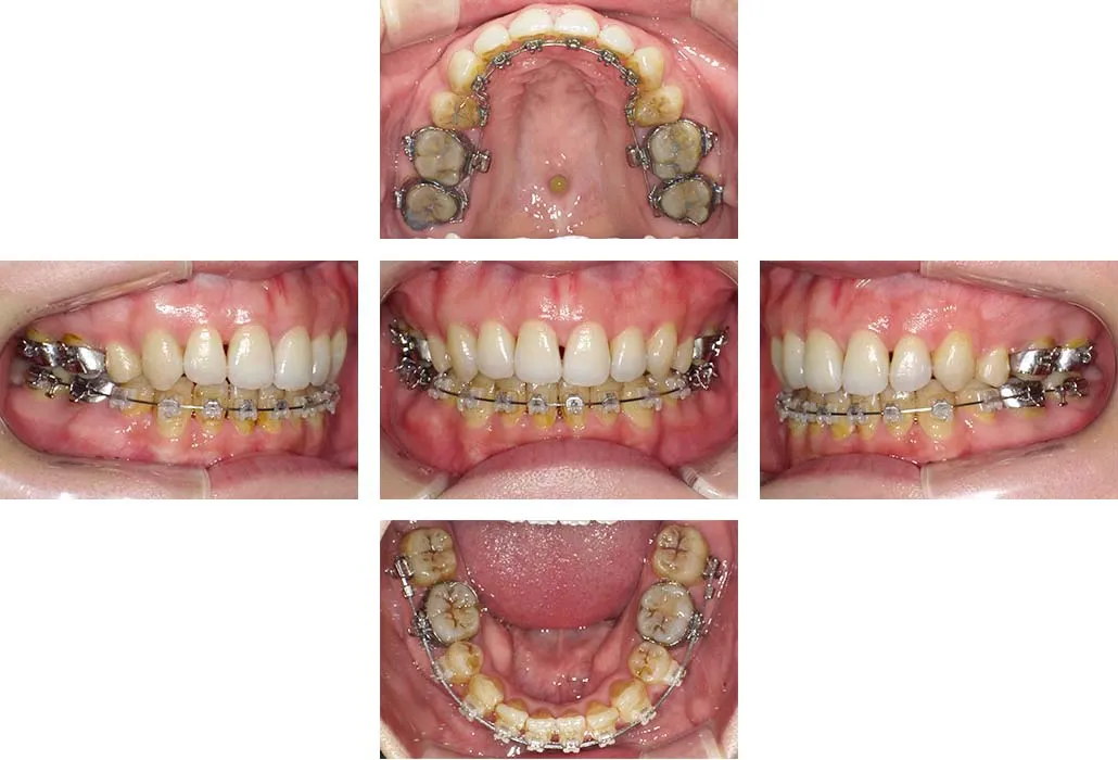 治療経過（動的治療終了時）