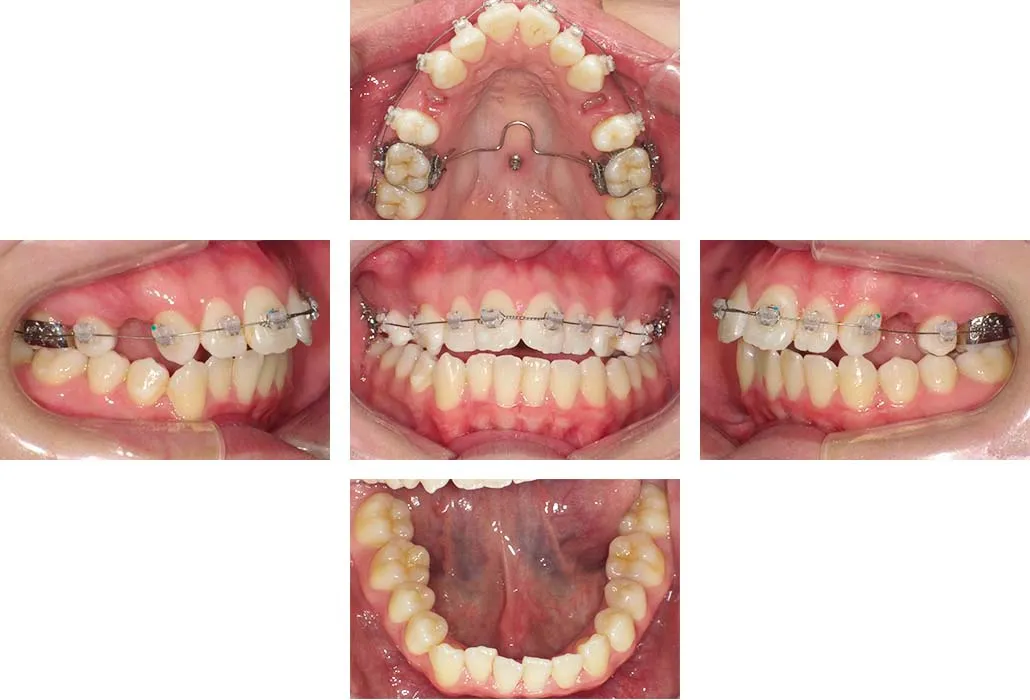 治療経過（動的治療開始時）
