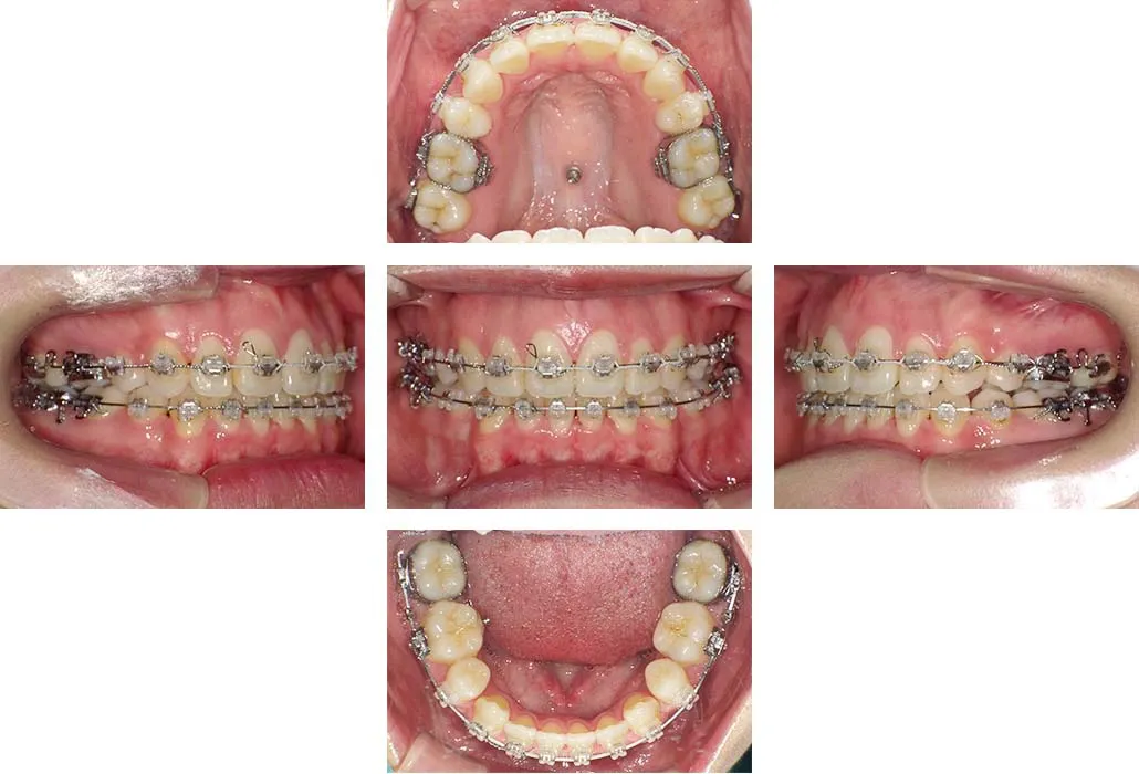 治療経過（動的治療終了時）