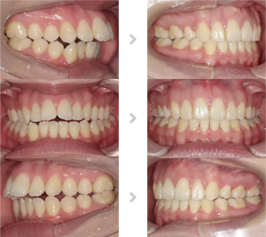 術前術後の比較