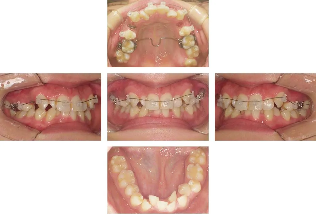 治療経過（動的治療開始時）