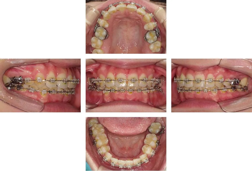 治療経過（動的治療終了時）
