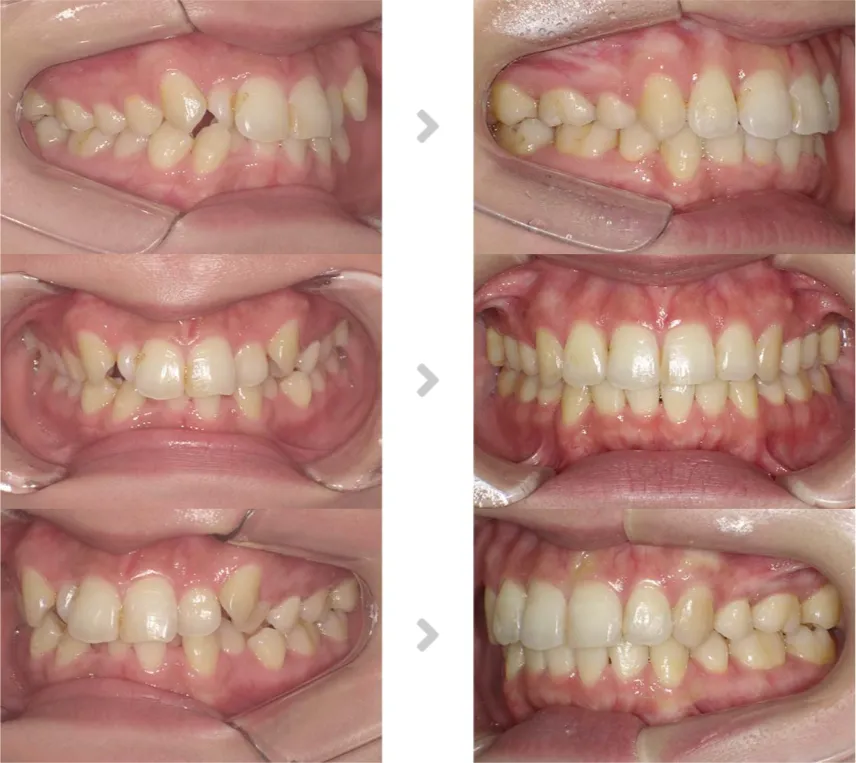 術前術後の比較