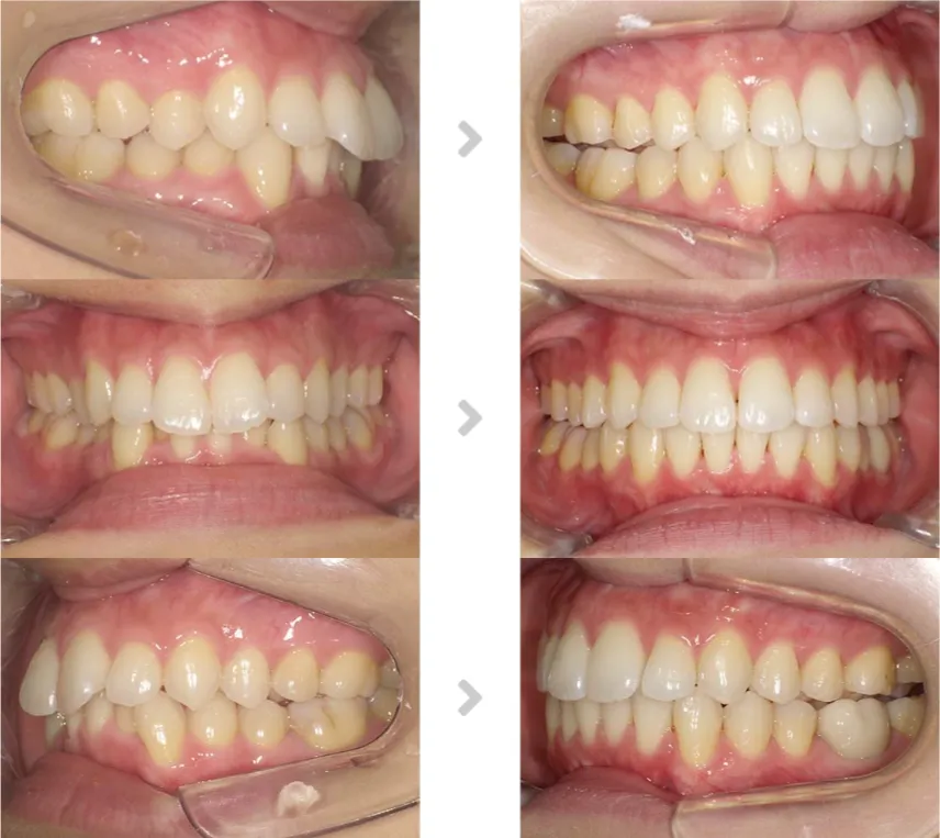術前術後の比較