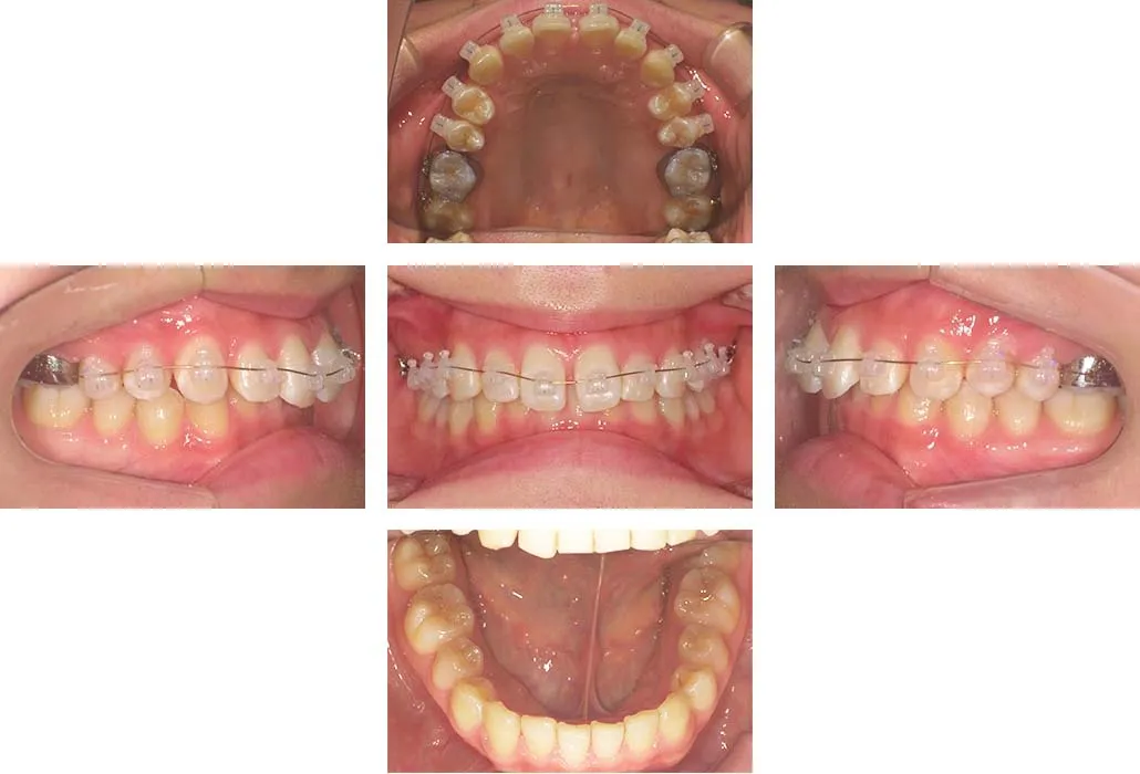 治療経過（動的治療開始時）