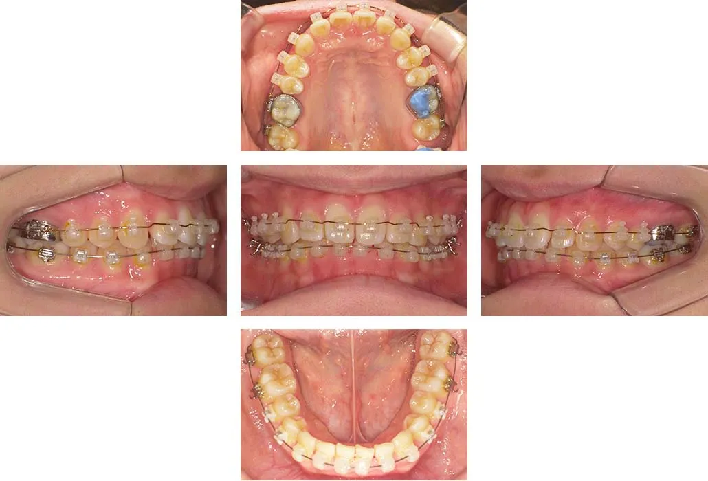 治療経過（動的治療終了時）
