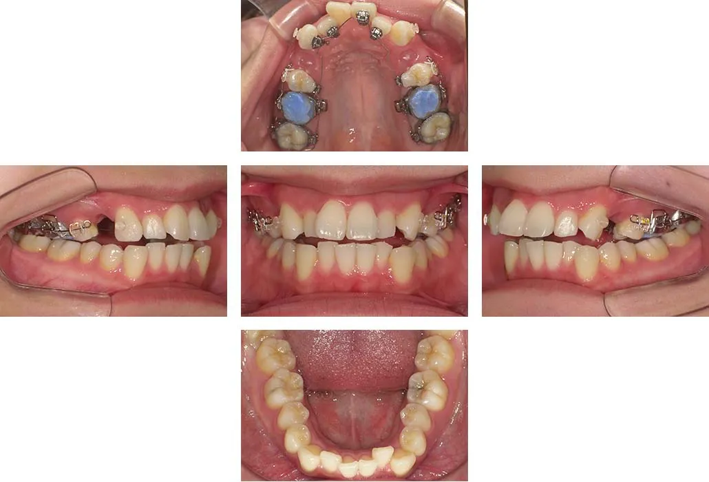 治療経過（動的治療開始時）