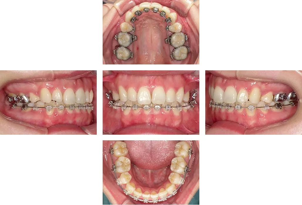 治療経過（動的治療終了時）