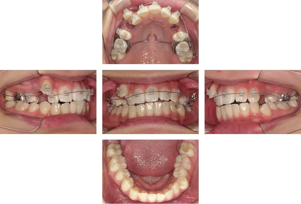 治療経過（動的治療開始時）