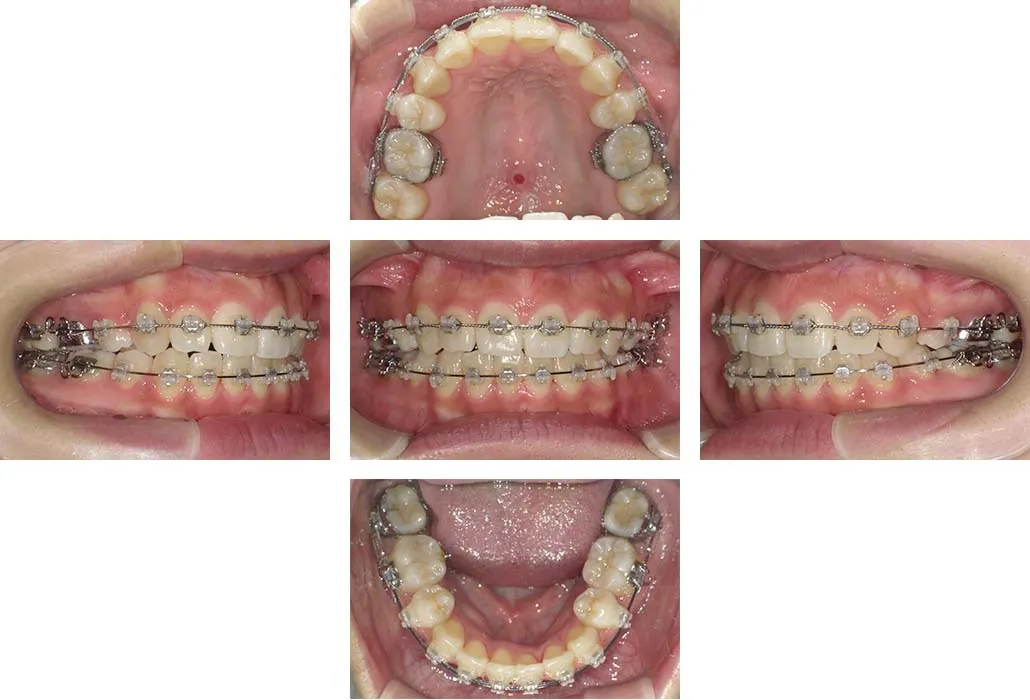 治療経過（動的治療終了時）
