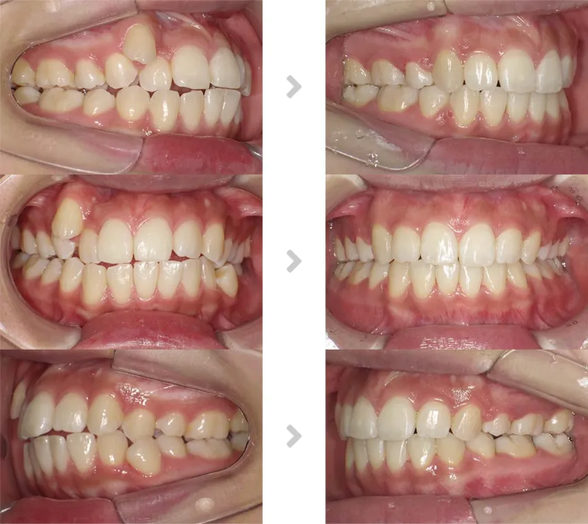 術前術後の比較