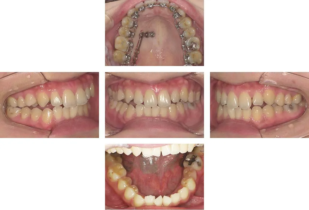 治療経過（動的治療開始時）