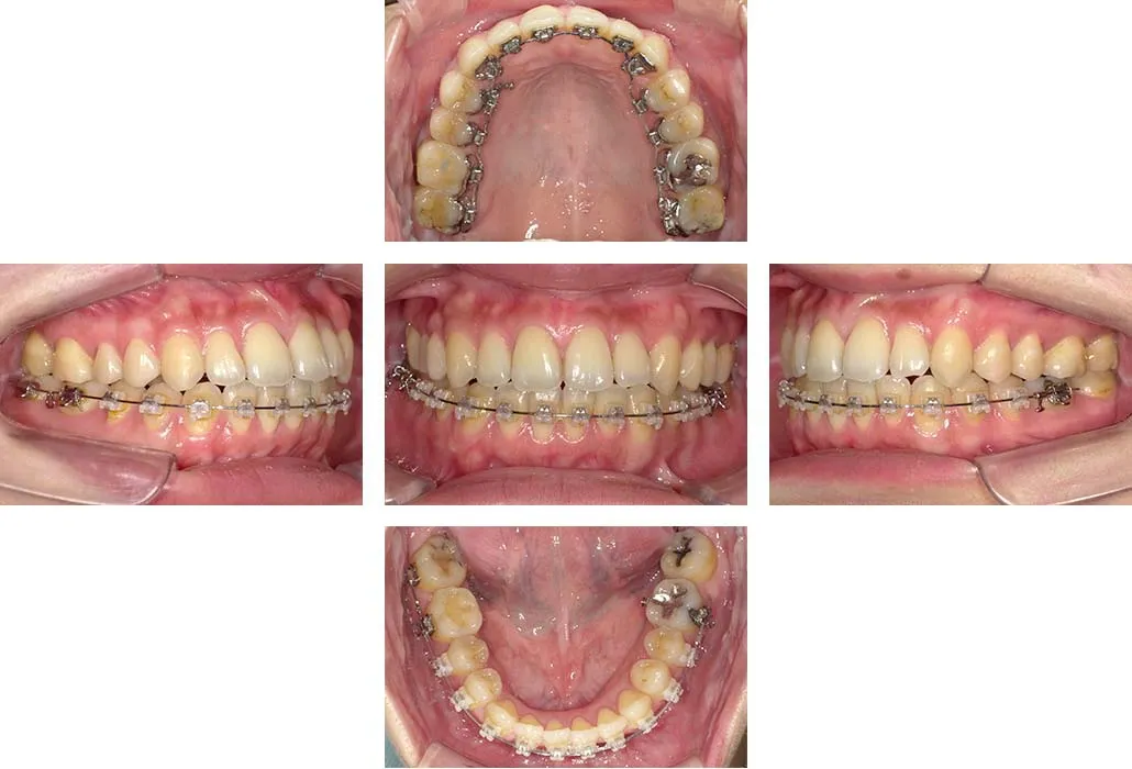 治療経過（動的治療終了時）