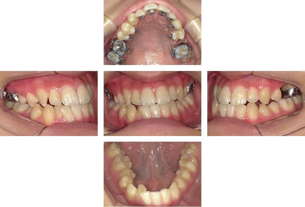 治療経過（動的治療開始時）