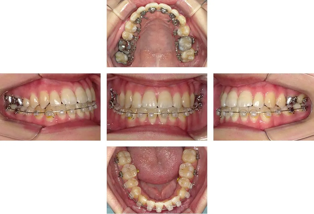 治療経過（動的治療終了時）