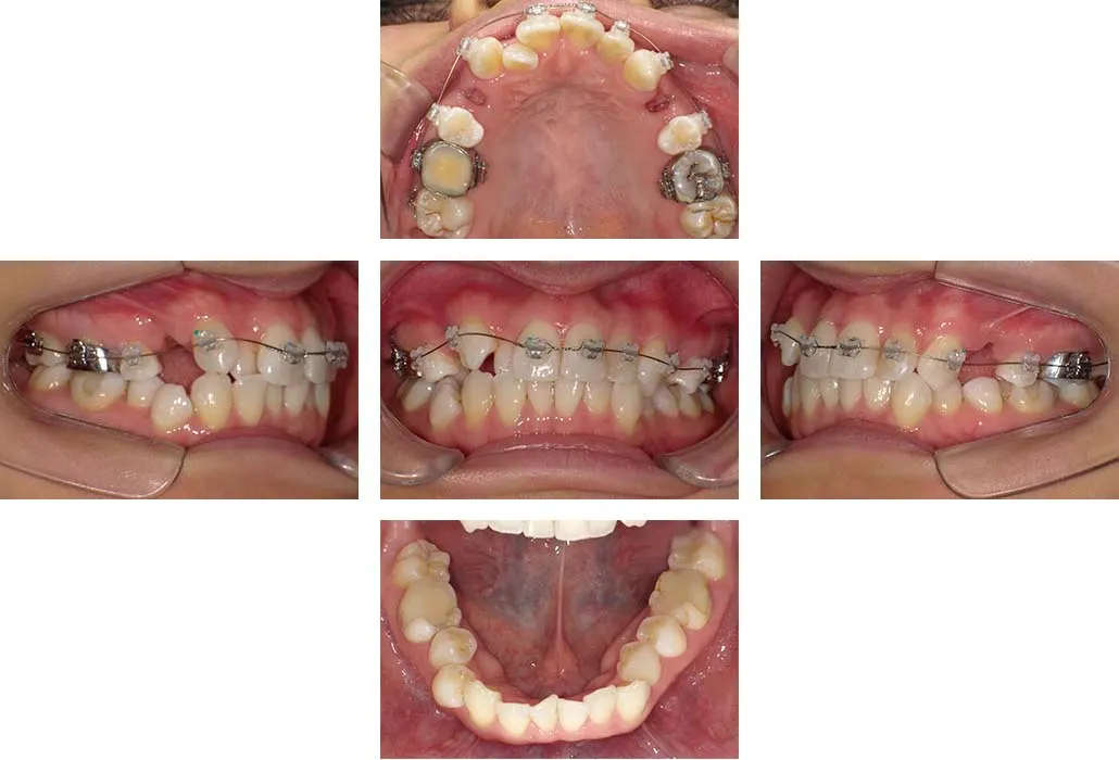 治療経過（動的治療開始時）