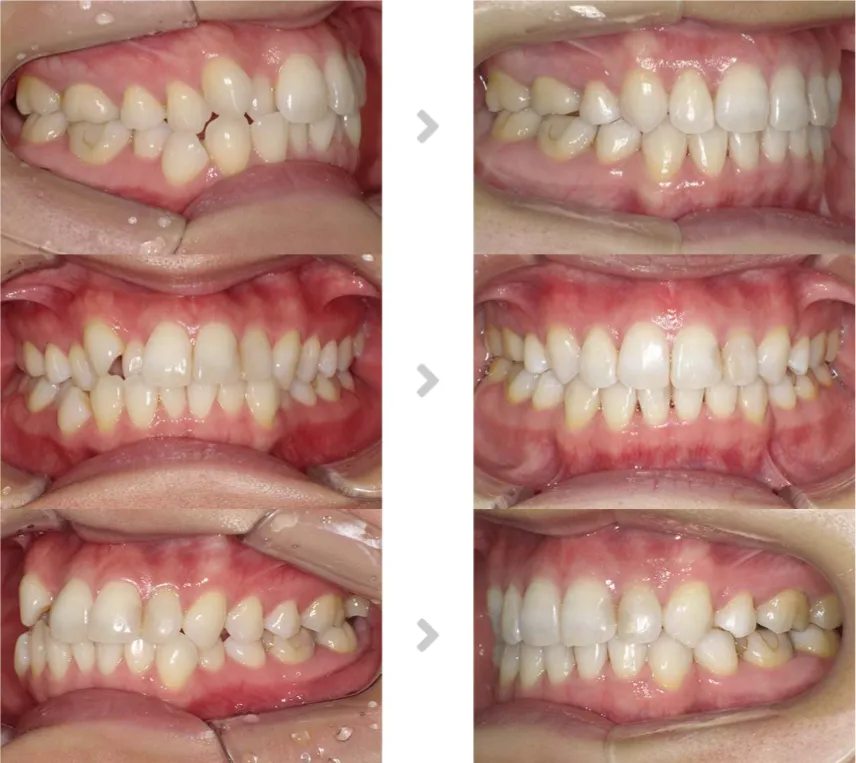 術前術後の比較