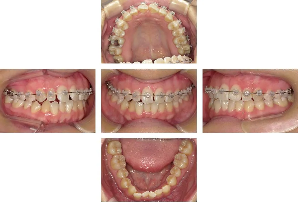 治療経過（動的治療開始時）