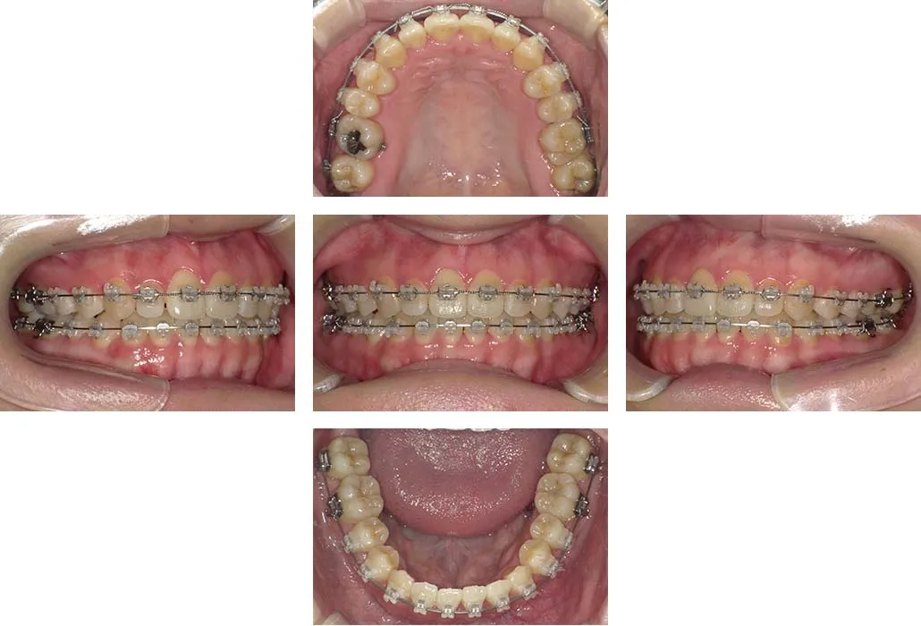 治療経過（動的治療終了時）