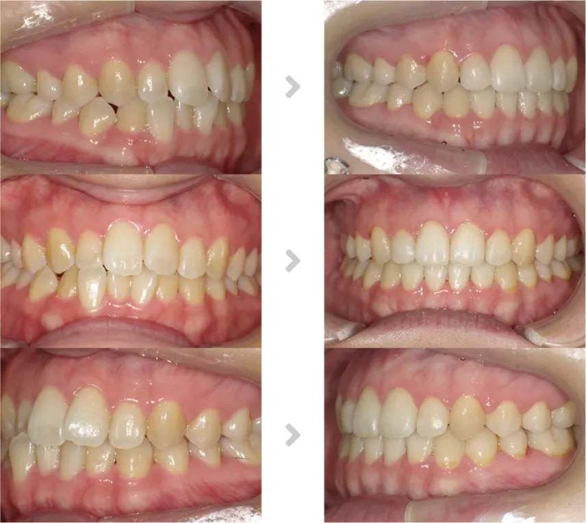 術前術後の比較