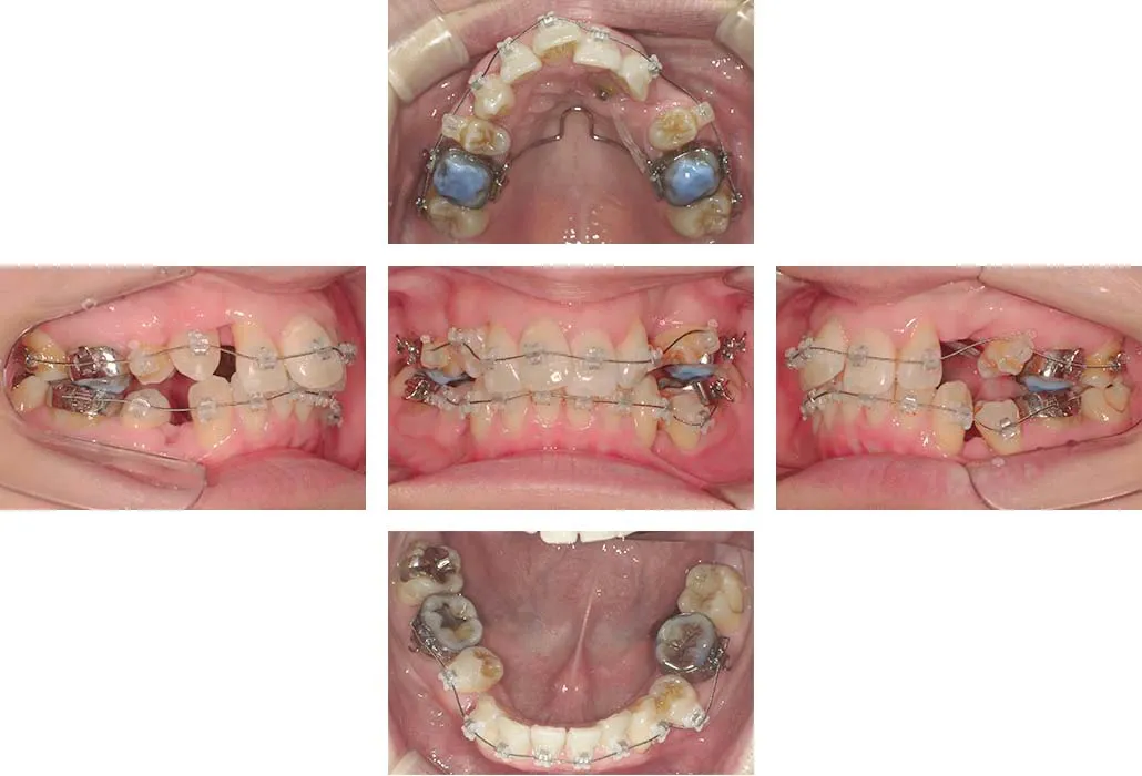 治療経過（動的治療開始時）