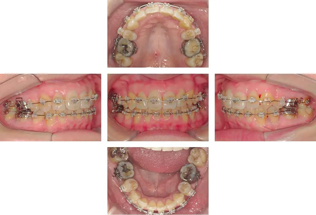 治療経過（動的治療終了時）